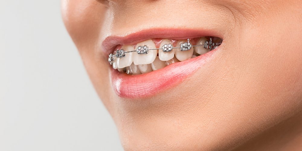 Beautiful young woman with teeth braces on gray